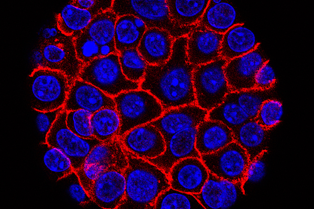 Pancreatic cancer cells, nuclei in blue, growing as a sphere encased in membranes, red.