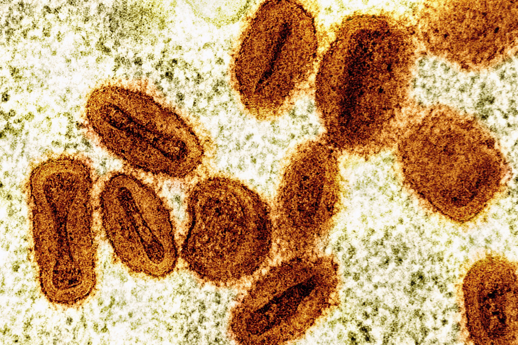 Under Arrest For Brining Deactivated Mpox Virus Into U.S.