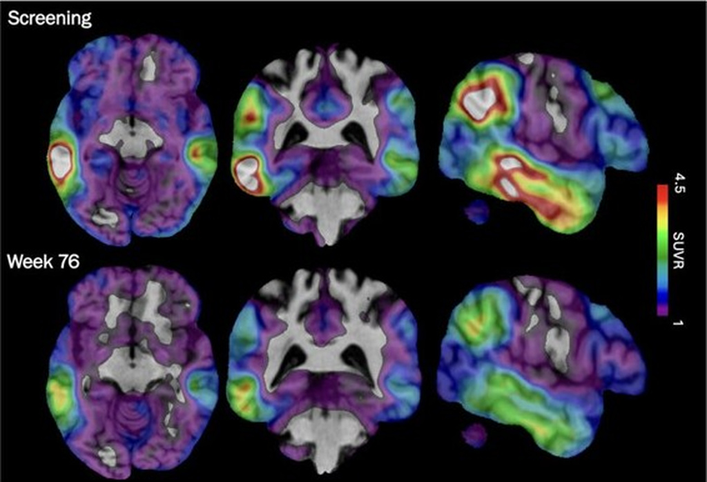 Experimental Alzheimer's Drug Shows Promise