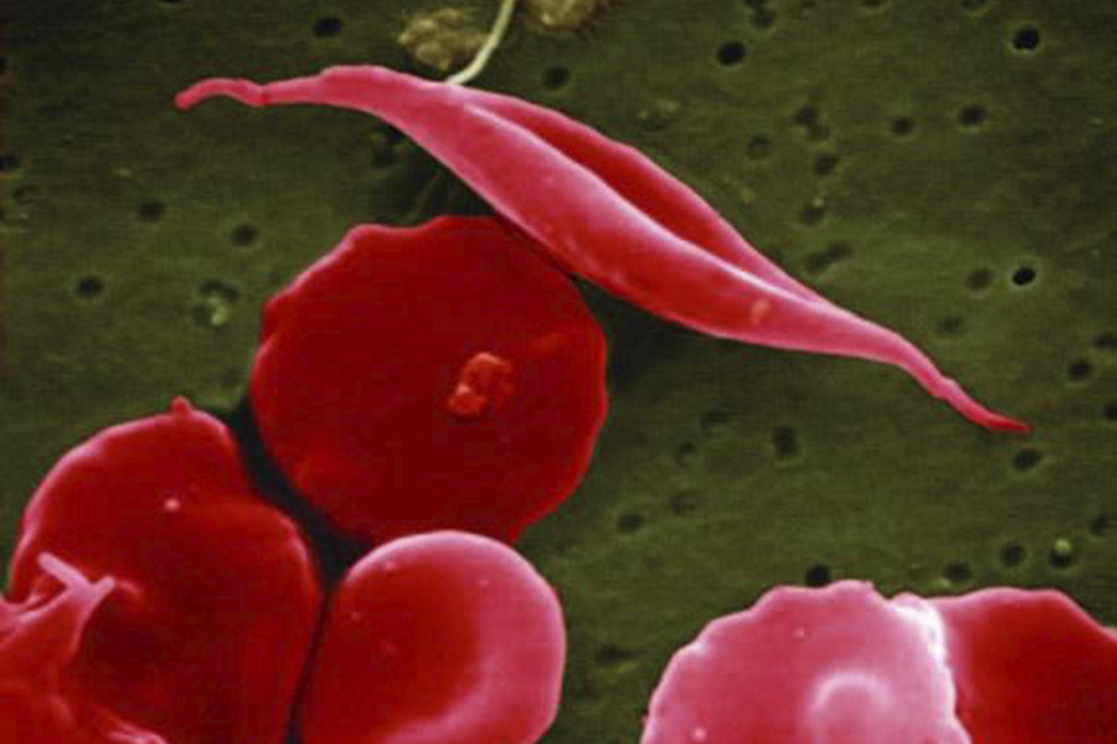 two-treatments-for-sickle-cell-disease-approved-positive-encouraging